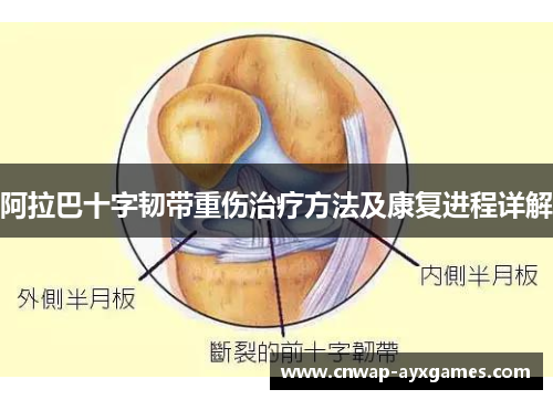 阿拉巴十字韧带重伤治疗方法及康复进程详解